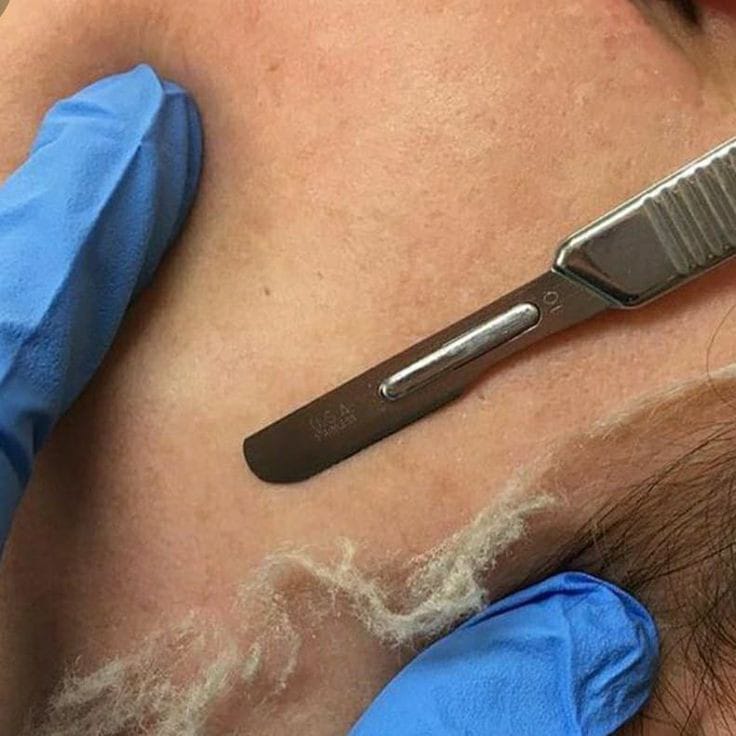 Dermaplaning