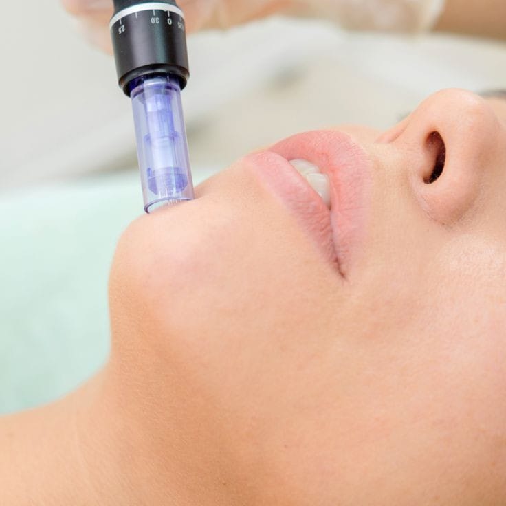 Microneedling procedimiento